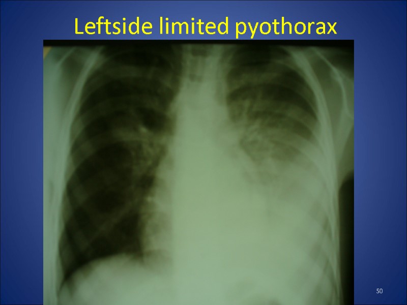 Leftside limited pyothorax 50